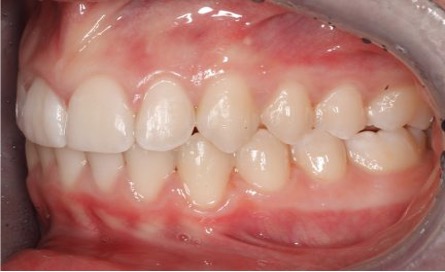 Close up of mouth opened and teeth displayed and straightened after Invisalign treatment