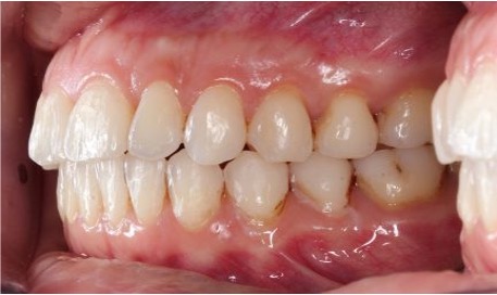 Close up of whitened bite of teeth after Invisalign treatment displaying straight teeth