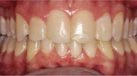 Close up photo of straightened teeth after procedure