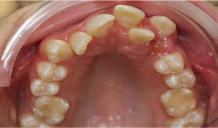 Close up image of crooked teeth