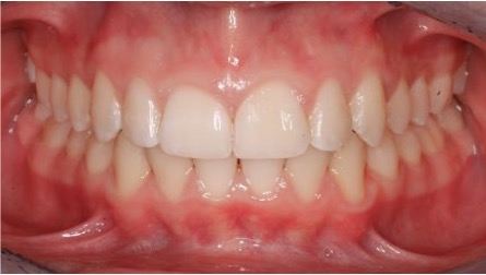 Close up of straightened teeth showing success of treatment offered