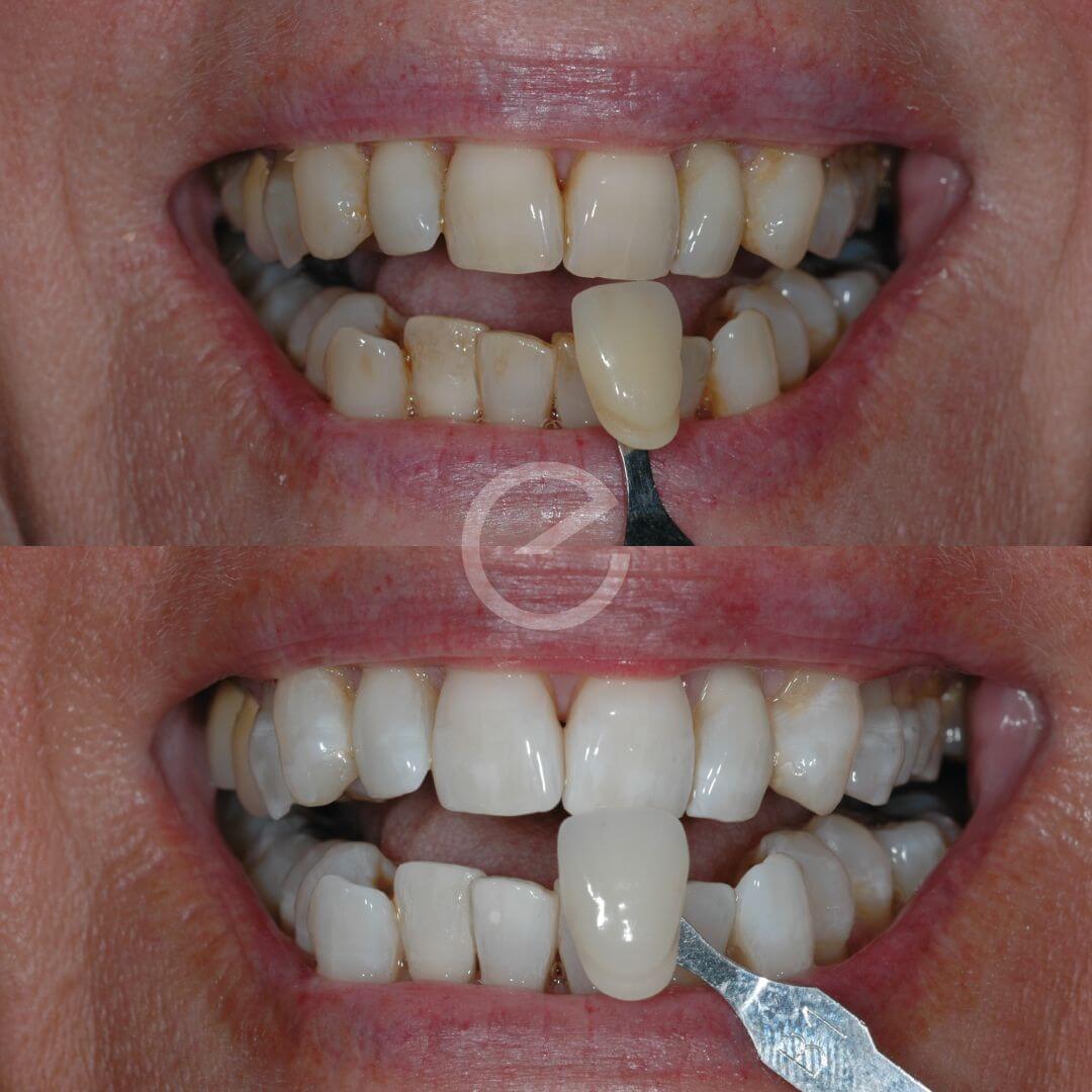 Teeth Whitening Milton Keynes Oxley Park Dental Practice